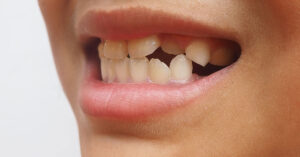 crooked teeth
