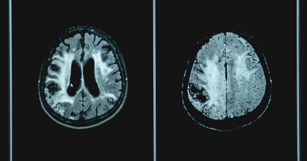 Vacular dementia MRI brain