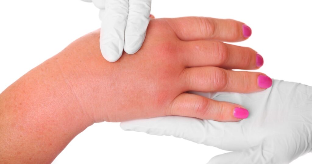 A picture of a swollen hand due to a wasp sting being examined by a doctor over white background