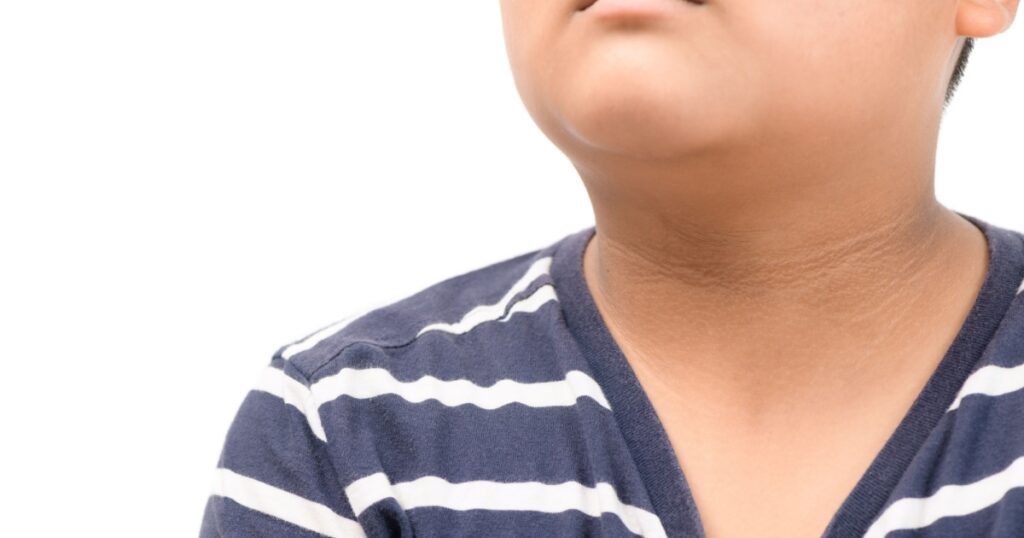 Black marks of the skin around the neck of overweight children isolated on white background, One of the warning signs of diabetes.