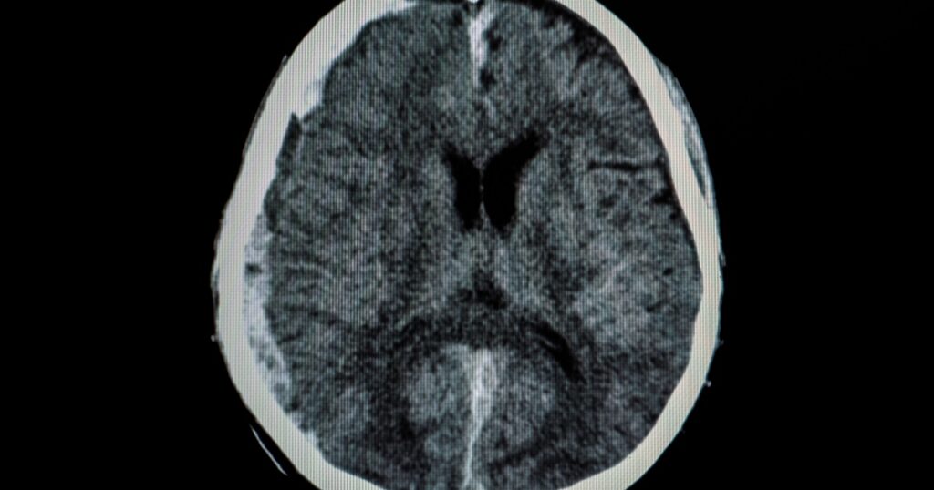 CT scan of a brain of a patient with subdural hemorrhage, interhemispheric hemorrhage and cerebral edema from trauamatic brain injury (TBI).