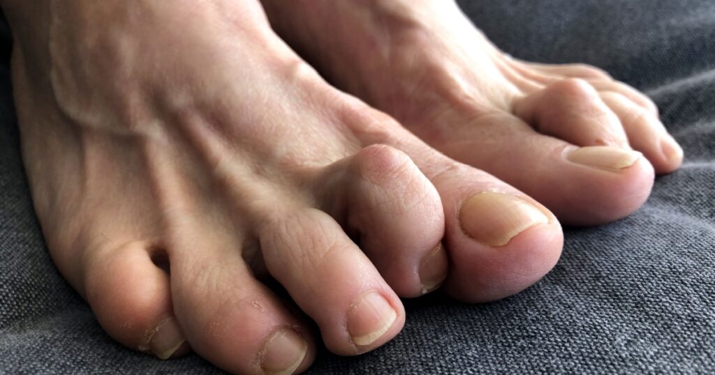 Woman's foot with hammer toe.