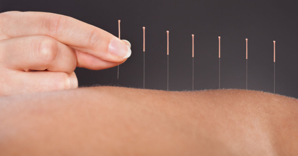 Close-up Of A Person Getting An Acupuncture Treatment At Spa