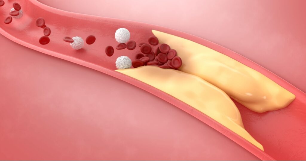Thickened Arteries and Veins, Coronary heart disease, High cholesterrol, 3D Rendering.