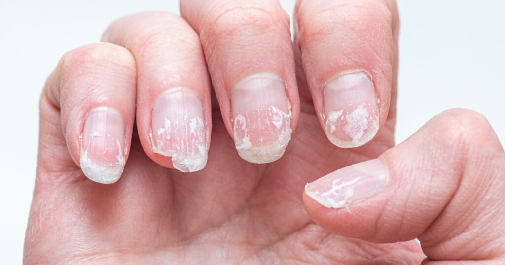 Flaky bitten and brittle nails without a manicure. Regrown nail cuticle and damaged nail plate after gel polish.