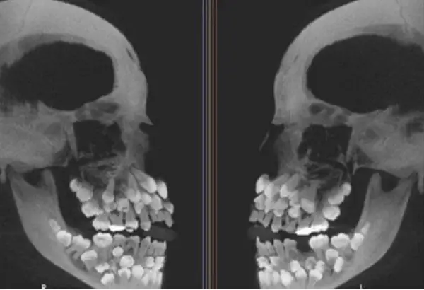 human body Hyperdontia Unveiled: The Curious Case of Extra Teeth