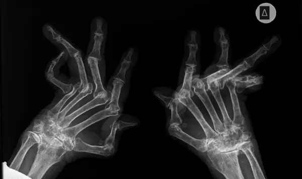 X-Ray Revelation: Understanding the Devastating Impact of Arthritis