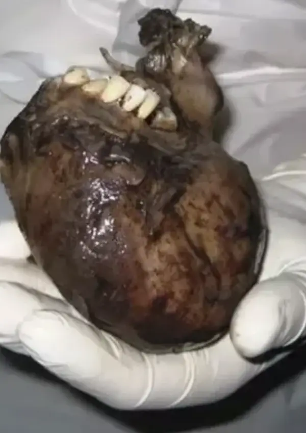 human body The Terror of Teratomas: Tumors with a Disturbing Twist