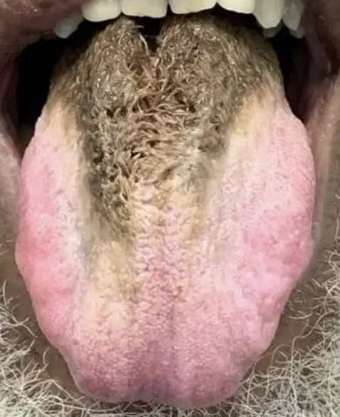 human body Keratin Quirks: Unusual Tongue Growth Revealed