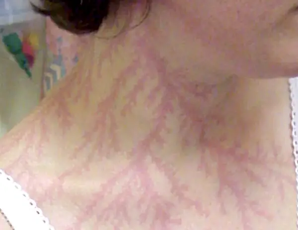 Electrifying Patterns: Unveiling the Lichtenberg Figure