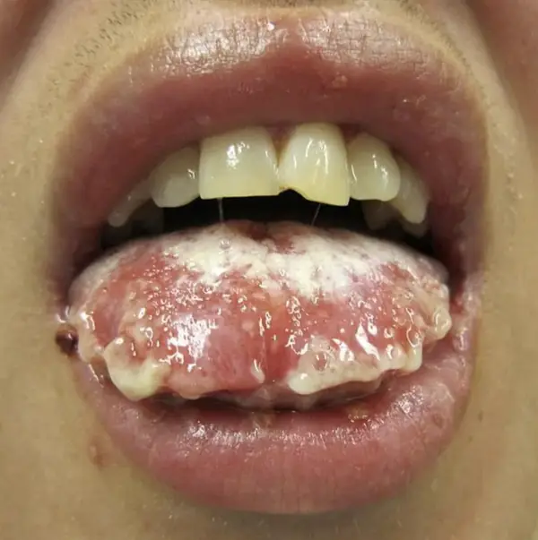human body Tongue Troubles: Stevens-Johnson Syndrome Visualized