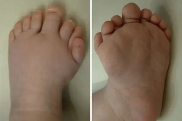 Mirrored Feet: A Reflection of Mirror Foot Syndrome