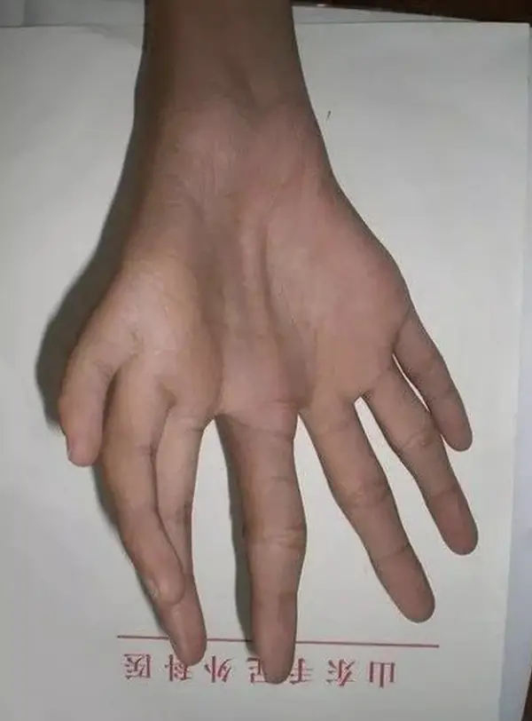 human body Digit Diversity: Another Look at Polydactyly