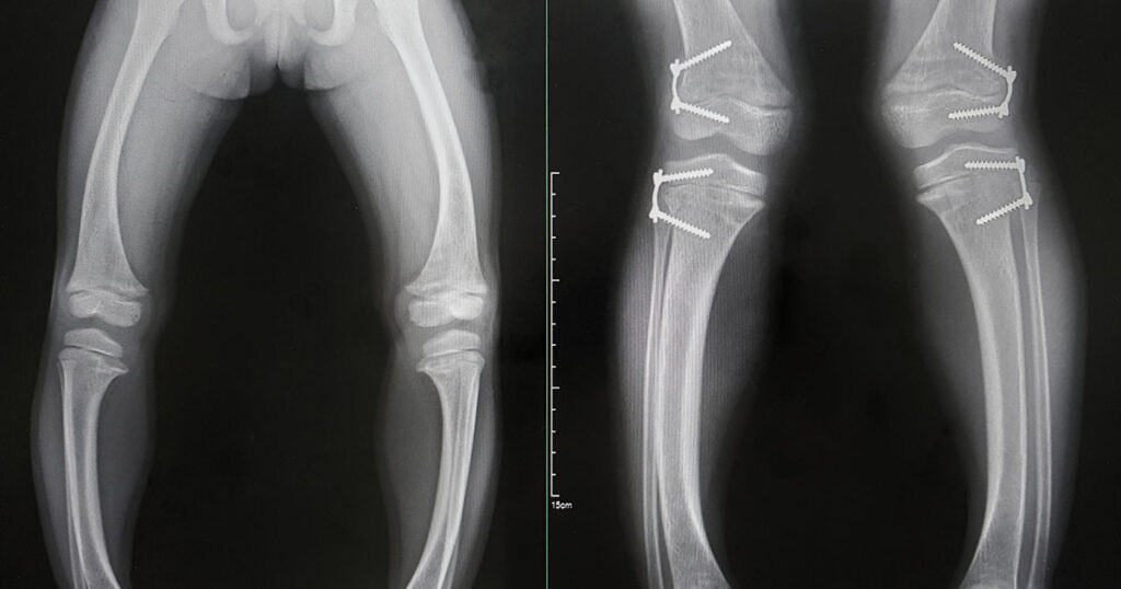 The Connection Between Arthritis and Vitamin D - Featured image