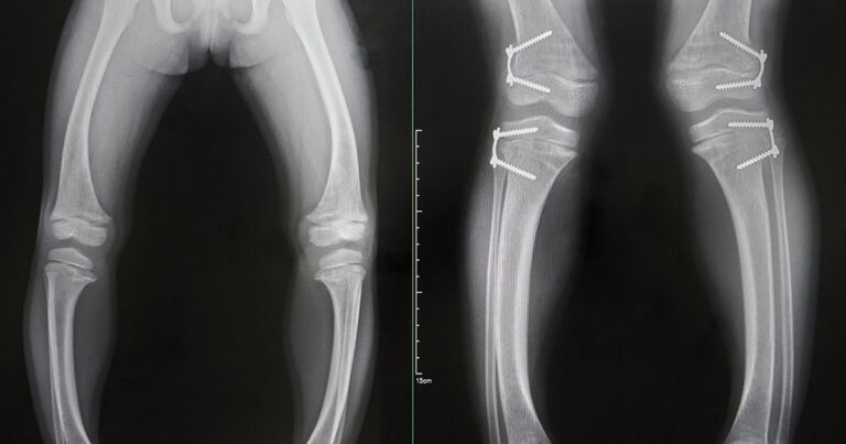 The Connection Between Arthritis and Vitamin D - Featured image