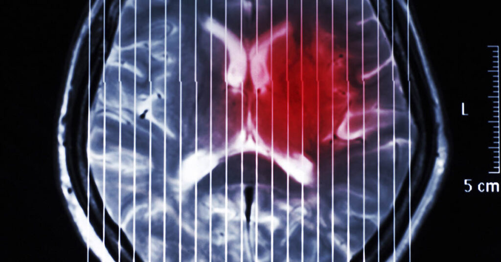 Brain Cancer Treatment Shows Promise As Tumor Almost Disappears in 5 Days - Featured image