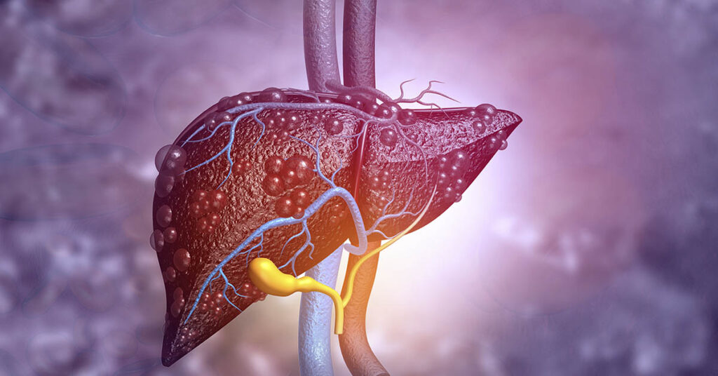 10 Signs of Liver Disease to Never Ignore - Featured image