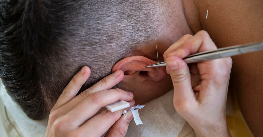 What Are Ear Seeds, and How Do They Work? - Featured image