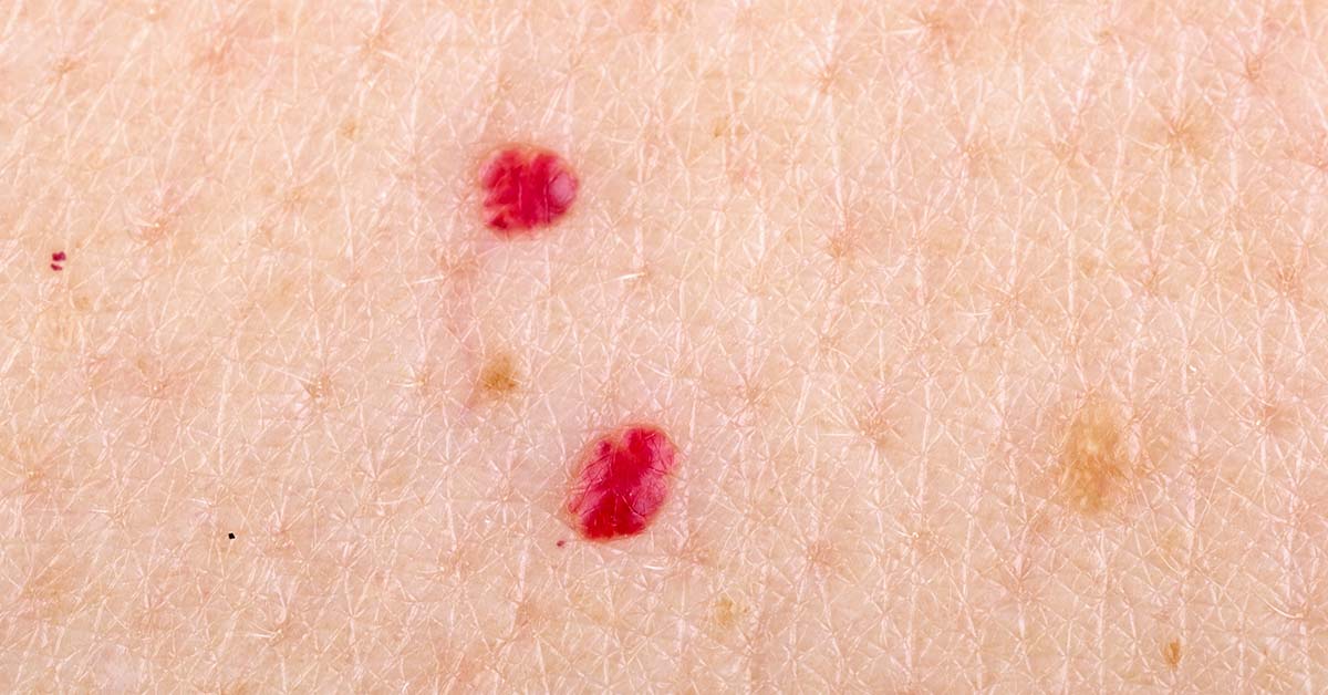 close up of red dots on skin