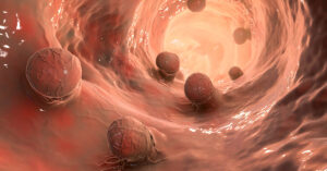 8 Symptoms of Colon Polyps and 4 Signs They May Be Cancerous 3D rendering, internal view of colon showing Colon Polyps