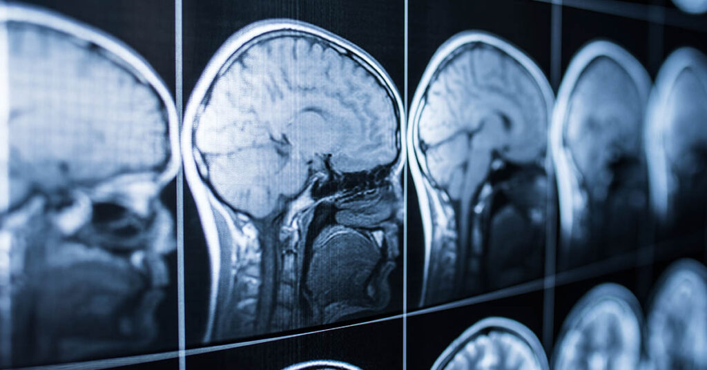 Doctors Thought Woman Had Cancer, But It Was Actually a Brain-Eating Amoeba - Featured image