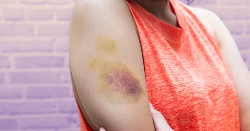 10 Reasons Why You’re Bruising Easily - Featured image