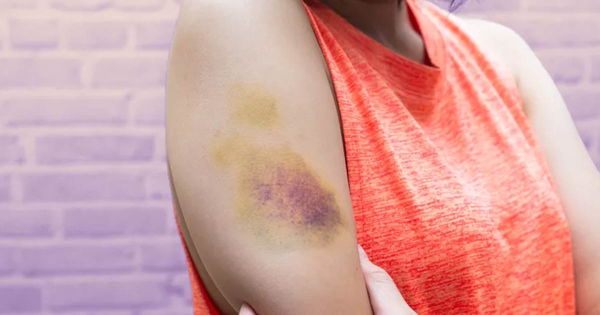 person with large bruise on arm