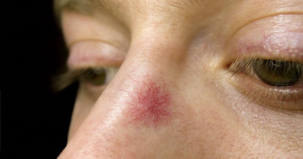 Spider hemangioma on the skin of the nose - capillary telangiectasia on the face