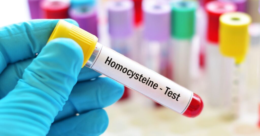 Blood sample tube for homocysteine test, diagnosis for heart disease