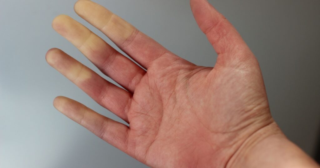 Medical picture of a women hand with raynaulds syndrome.