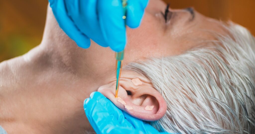 Auriculotherapy, or auricular treatment on human ear, close up. Therapist hand applying acupuncture ear seed sticker with tweezers.