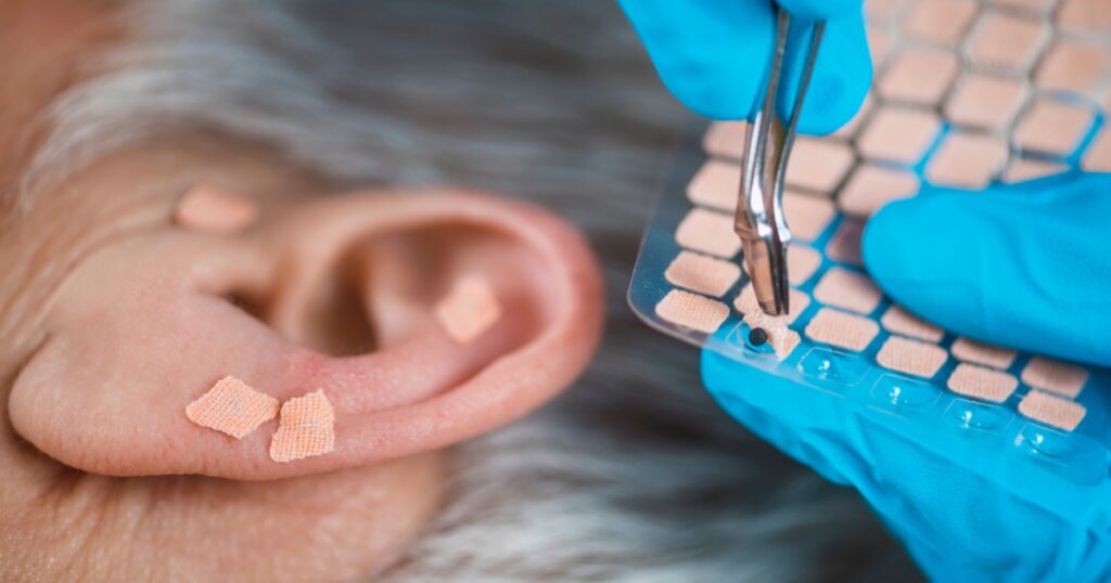 Auriculotherapy, or auricular treatment on human ear, close up. Therapist hand applying acupuncture ear seed sticker with tweezers.
