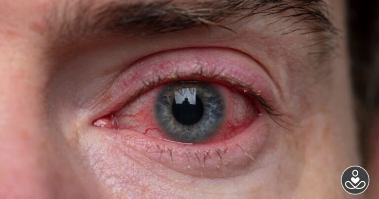How to Help Prevent 8 Common Eye Issues - Featured image