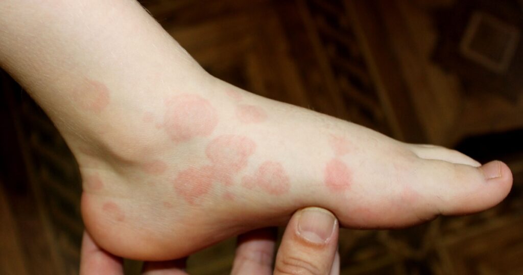 A case of erythema multiforme in a child