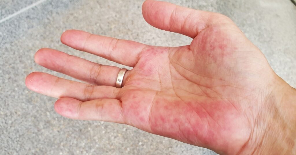 Unusual red on the palm hand from SLE symptom effect blood system. Systemic lupus erythematosus (SLE) is a chronic disease caused by self-immunity which causes effects on the organs and blood system.