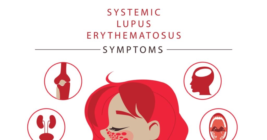 Systemic lupus erythematosus. A woman with a red spot on her face in the shape of a butterfly. Illustration of the main symptom of SLE. common lupus symptoms logo icon. Vector illustration of