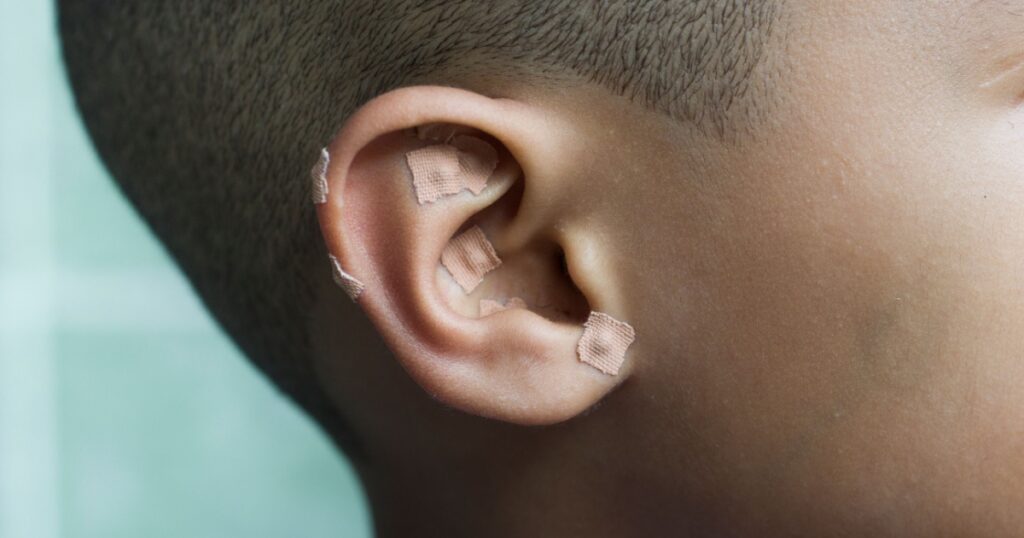 Auriculotherapy, or auricular therapy, or ear acupuncture, or auriculoacupuncture is a form of alternative medicine based on the idea that the ear is a microsystem which reflects the entire body.