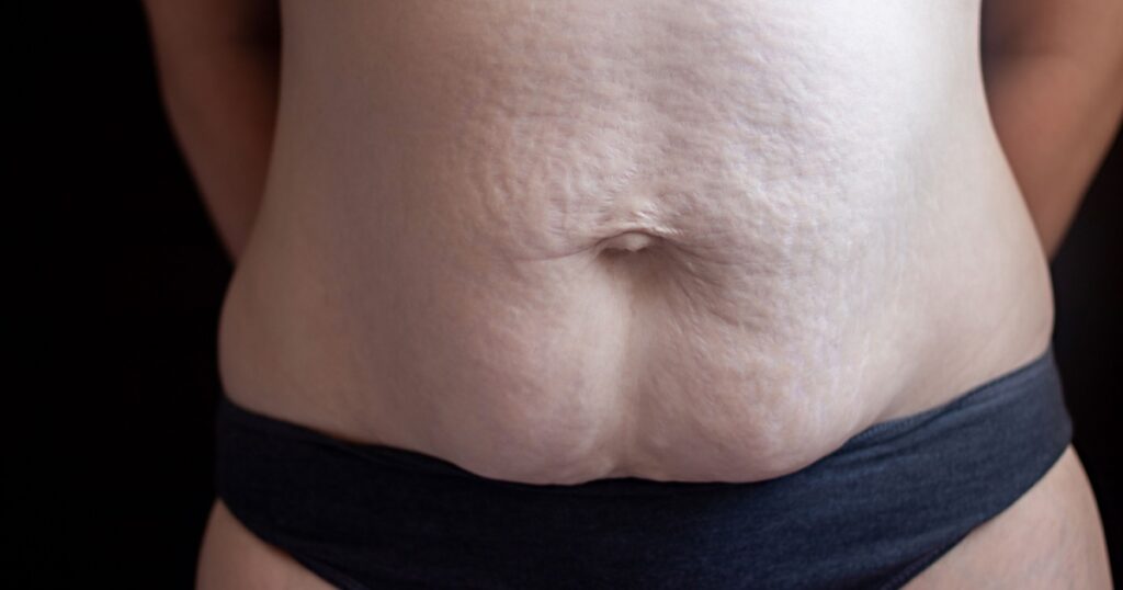 White woman displaying large stretch marks, striae on skin after pregnancy, childbirth. Concept of diastasis recti, lesion skin. Selective focus