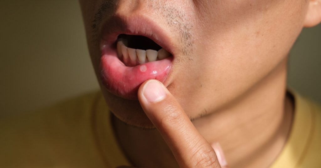 close up man's lip have a mouth ulcer. Stomatitis on the lip. Health problem concept.