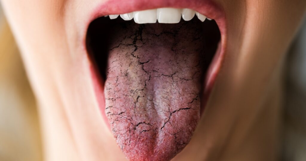 Woman Tongue With Bad Bacteria Candidiasis And Pain
