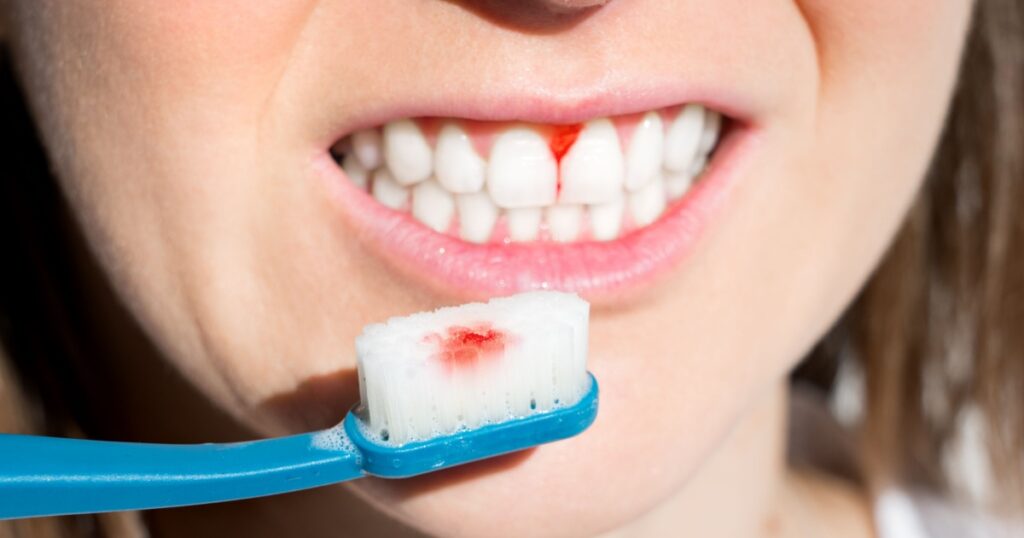 Woman with bleeding gums