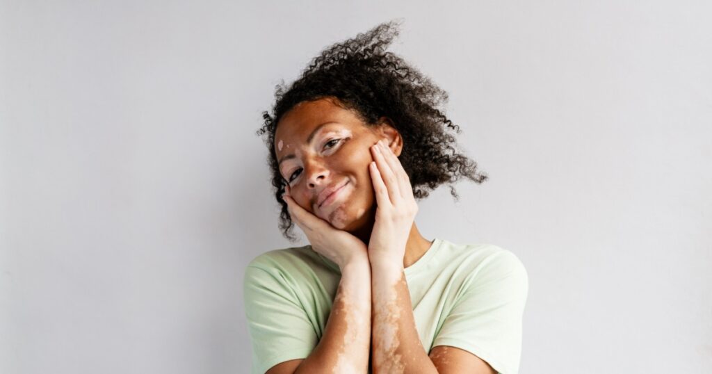 Young woman with vitiligo smiling while looking at camera isolated over white wall