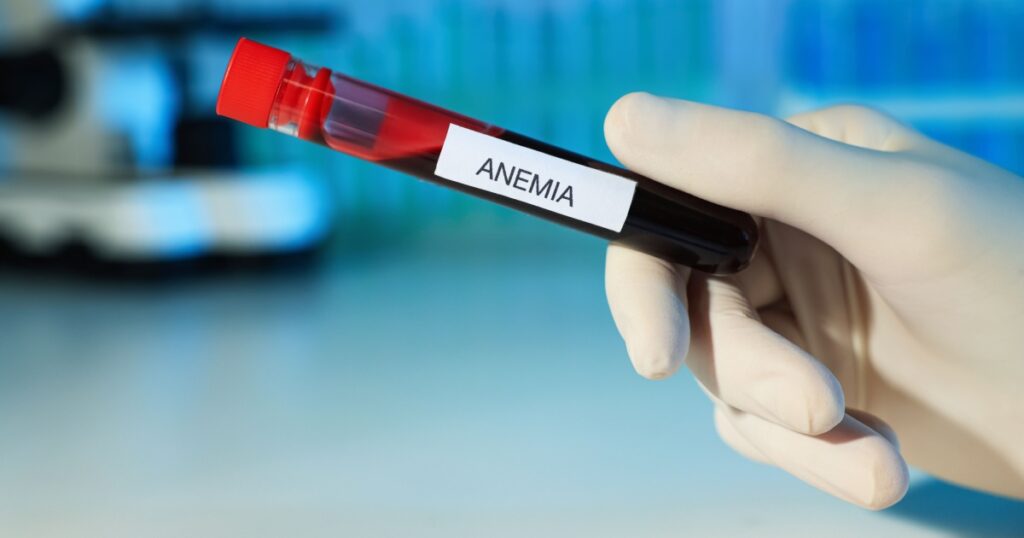 Scientist holding test tube with blood sample and label Anemia on blurred background, closeup