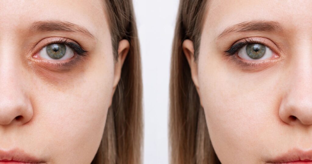 Cropped shot of young caucasian woman's face with dark circles under eyes before and after cosmetic treatment. Bruises under eyes caused by fatigue, insomnia. Result of therapy,use of foundation cream