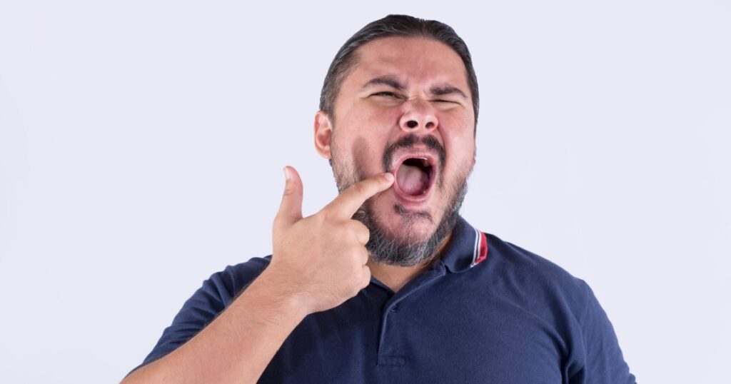 A man suffering from angular cheilitis. Pointing out the cracked, irritated sore on the corner of his mouth. Feeling discomfort and annoyance. Isolated on a white background