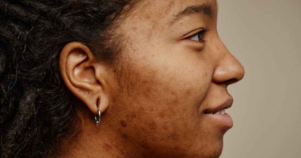Minimal profile portrait of ethnic young woman smiling with acne scars on face and ear piercings