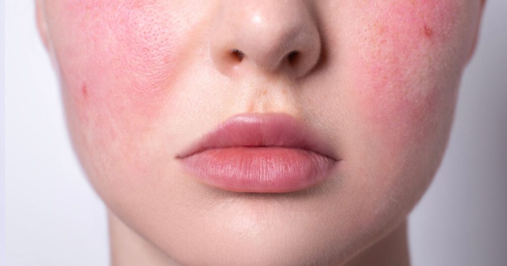 rosacea couperose redness skin, red spots on cheeks, young woman with sensitive skin, patient face close-up