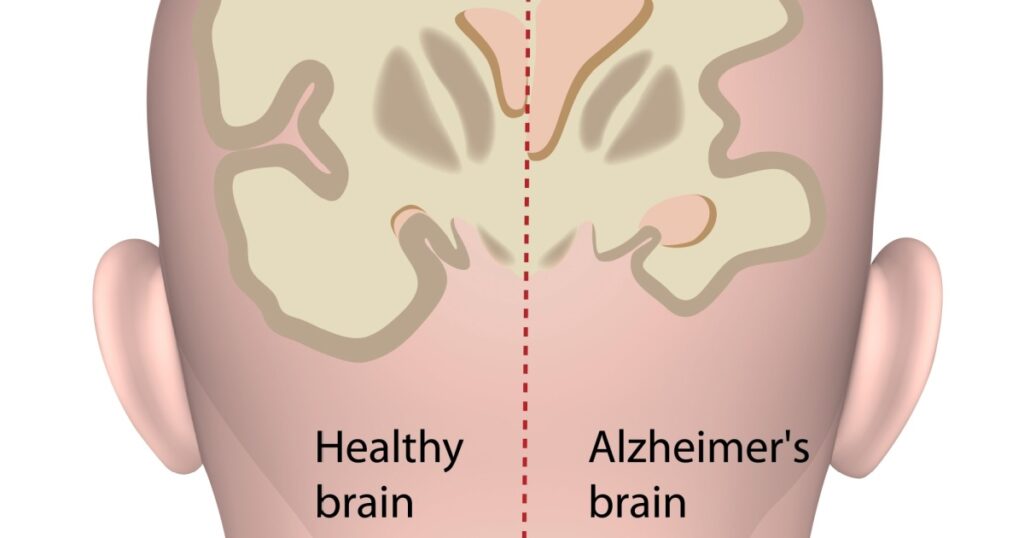 Healthy brain vs. Alzheimer's brain
