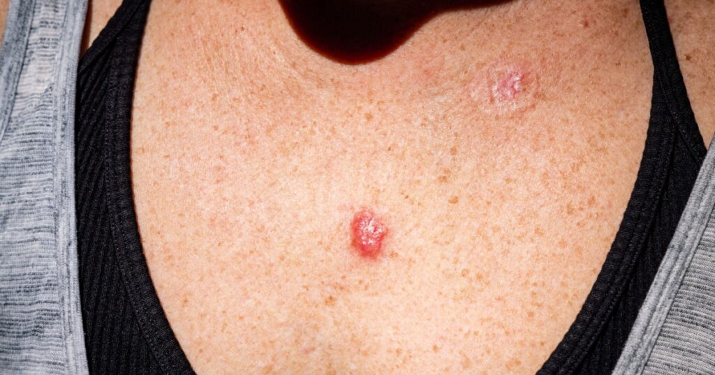 Young female 30s close up of chest prior to applying imiquimod cream medication to basal cell carcinoma.