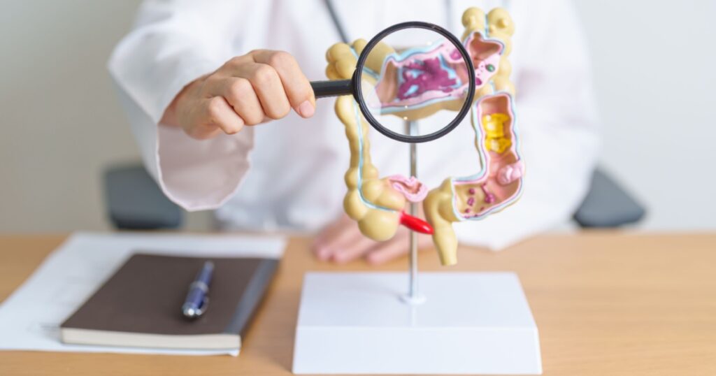 Doctor with human Colon anatomy model and magnifying glass. Colonic disease, Large Intestine, Colorectal cancer, Ulcerative colitis, Diverticulitis, Irritable bowel syndrome and Digestive system